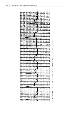 166 150 Practice ECGs: Interpretation and Review
Practice
ECG
103
A
68-year-old
woman
with
acute
inferior
MI.
Does
she
need
a
temporary
pacemaker?
 