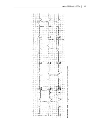 part ii: 150 Practice ECGs 167
Practice
ECG
104
A
55-year-old
man
with
palpitations
and
a
history
of
MI.
 