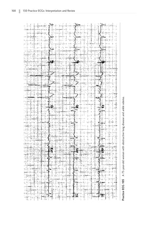 168 150 Practice ECGs: Interpretation and Review
Practice
ECG
105
A
75-year-old
woman
with
obstructive
lung
disease
and
ankle
edema.
 