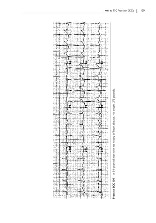 part ii: 150 Practice ECGs 169
Practice
ECG
106
A
54-year-old
man
with
no
history
of
heart
disease.
He
weighs
275
pounds.
 