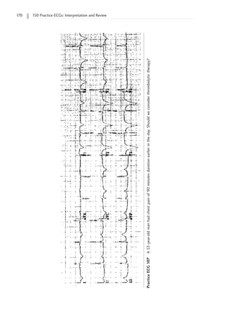 170 150 Practice ECGs: Interpretation and Review
Practice
ECG
107
A
53-year-old
man
had
chest
pain
of
90
minutes
duration
earlier
in
the
day.
Should
we
consider
thrombolytic
therapy?
 