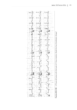 part ii: 150 Practice ECGs 171
Practice
ECG
108
A
70-year-old
woman
with
chest
pain
of
5
hours
duration.
Should
she
have
thrombolytic
therapy?
 