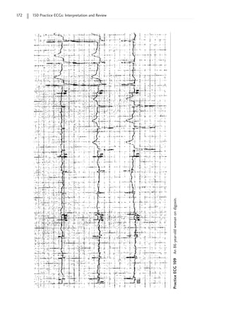 172 150 Practice ECGs: Interpretation and Review
Practice
ECG
109
An
86-year-old
woman
on
digoxin.
 