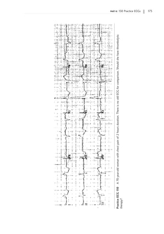 part ii: 150 Practice ECGs 173
Practice
ECG
1
10
A
70-year-old
woman
with
chest
pain
of
2
hours
duration.
There
is
no
old
ECG
for
comparison.
Should
she
have
thrombolytic
therapy?
 
