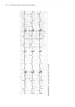 174 150 Practice ECGs: Interpretation and Review
Practice
ECG
1
1
1
Same
patient
(No.
1
10),
3
hours
later.
 