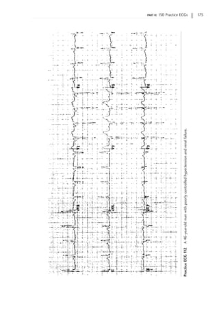 part ii: 150 Practice ECGs 175
Practice
ECG
1
12
A
46-year-old
man
with
poorly
controlled
hypertension
and
renal
failure.
 