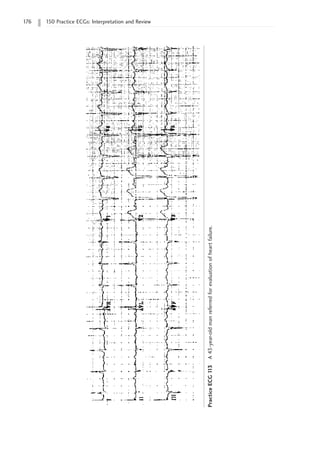 176 150 Practice ECGs: Interpretation and Review
Practice
ECG
1
13
A
43-year-old
man
referred
for
evaluation
of
heart
failure.
 