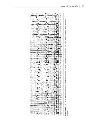 part ii: 150 Practice ECGs 177
Practice
ECG
1
14
A
52-year-old
woman
with
palpitations.
There
is
no
other
history
of
heart
disease.
This
is
her
second
episode.
What
workup
is
needed?
 
