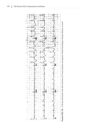 178 150 Practice ECGs: Interpretation and Review
Practice
ECG
1
15
A
78-year-old
woman
with
chest
heaviness
of
5
hours
duration
and
dyspnea.
Would
thrombolytic
therapy
influence
survival?
 