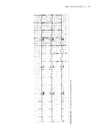 part ii: 150 Practice ECGs 179
Practice
ECG
1
16
A
41-year-old
man
on
the
psychiatric
unit.
 