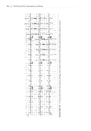 180 150 Practice ECGs: Interpretation and Review
Practice
ECG
1
17
A
19-year-old
woman
with
cyanosis,
lethargy,
and
a
history
of
heart
murmur.
What
other
physical
findings
would
you
expect?
 