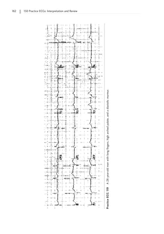 182 150 Practice ECGs: Interpretation and Review
Practice
ECG
1
19
A
28-year-old
man
with
long
fingers,
high
arched
palate,
and
a
diastolic
murmur.
 