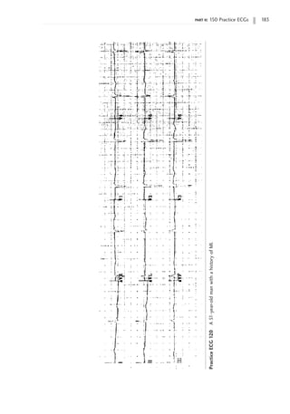 part ii: 150 Practice ECGs 183
Practice
ECG
120
A
51-year-old
man
with
a
history
of
MI.
 