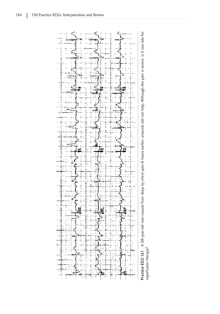 184 150 Practice ECGs: Interpretation and Review
Practice
ECG
121
A
68-year-old
man
roused
from
sleep
by
chest
pain
6
hours
earlier;
antacids
did
not
help.
Although
the
pain
is
severe,
is
it
too
late
for
reperfusion
therapy?
 