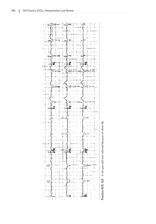 186 150 Practice ECGs: Interpretation and Review
Practice
ECG
123
A
56-year-old
man
referred
because
of
silent
MI.
 
