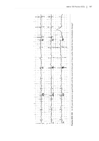 part ii: 150 Practice ECGs 187
Practice
ECG
124
An
82-year-old
woman
in
good
health
until
the
onset
of
chest
pain
2
hours
earlier.
Should
she
have
thrombolytic
therapy?
 