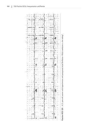 188 150 Practice ECGs: Interpretation and Review
Practice
ECG
125
A
51-year-old
woman
with
hypertension
and
paroxysmal
atrial
fibrillation.
Which
medicines
is
she
taking?
 
