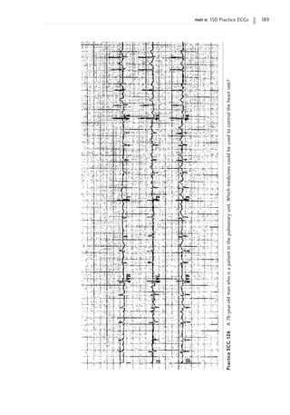part ii: 150 Practice ECGs 189
Practice
ECG
126
A
76-year-old
man
who
is
a
patient
in
the
pulmonary
unit.
Which
medicines
could
be
used
to
control
the
heart
rate?
 