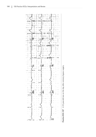 190 150 Practice ECGs: Interpretation and Review
Practice
ECG
127
A
35-year-old
man
on
the
day
after
coronary
bypass
surgery.
 