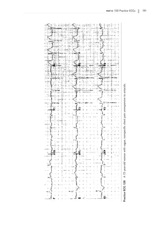 part ii: 150 Practice ECGs 191
Practice
ECG
128
A
72-year-old
woman
with
vague,
nonspecific
chest
pain
unresponsive
to
antacids.
 