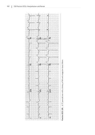 192 150 Practice ECGs: Interpretation and Review
Practice
ECG
129
A
77-year-old
man
with
a
history
of
MI
and
congestive
heart
failure.
 