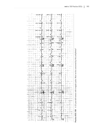 part ii: 150 Practice ECGs 193
Practice
ECG
130
A
23-year-old
woman
with
irregular
pulse.
Must
we
be
concerned
by
this
arrhythmia?
 