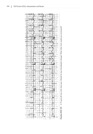 194 150 Practice ECGs: Interpretation and Review
Practice
ECG
131
A
73-year-old
man
with
chest
pain.
Should
he
have
thrombolytic
therapy?
What
other
tests
would
you
recommend?
 