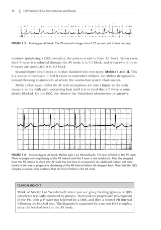 14 150 Practice ECGs: Interpretation and Review
ventricle (producing a QRS complex), the patient is said to have 2:1 block. When every
third P wave is conducted through the AV node, it is 3:1 block; and when two of three
P waves are conducted, it is 3:2 block.
Second-degree heart block is further classified into two types: Mobitz I and II. This
is a source of confusion. I find it easier to remember without the Mobitz designations,
instead thinking anatomically of where the conduction system block occurs.
Mobitz I block occurs within the AV node (exceptions are rare.) Injury to the node
causes it to tire with each succeeding beat until it is so tired that a P wave is com-
pletely blocked. On the ECG, we observe the Wenckebach phenomenon: progressive
FIGURE 1.6 Second-degree AV block, Mobitz type I (or Wenckebach). The level of block is the AV node.
There is progressive lengthening of the PR interval until the P wave is not conducted. After the dropped
beat, the PR interval is short (the AV node has had time to recuperate). An additional feature, not men-
tioned in the text, is progressive shortening of the RR interval before the dropped beat. Note that the QRS
complex is narrow, more evidence that the level of block is the AV node.
CLINICAL INSIGHT
Think of Mobitz I or Wenckebach when you see group beating (groups of QRS
complexes regularly separated by pauses). Then look for progressive prolongation
of the PR, then a P wave not followed by a QRS, and then a shorter PR interval
following the blocked beat. The diagnosis is supported by a narrow QRS complex,
since the level of block is the AV node.
FIGURE 1.5 First-degree AV block. The PR interval is longer than 0.22 second, and it does not vary.
 