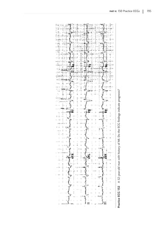 part ii: 150 Practice ECGs 195
Practice
ECG
132
A
52-year-old
man
with
history
of
MI.
Do
the
ECG
findings
indicate
prognosis?
 