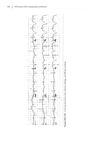 196 150 Practice ECGs: Interpretation and Review
Practice
ECG
133
A
55-year-old
woman
with
confusion,
lethargy,
and
difficulty
speaking.
 