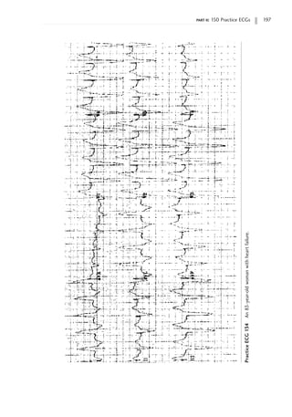 part ii: 150 Practice ECGs 197
Practice
ECG
134
An
83-year-old
woman
with
heart
failure.
 
