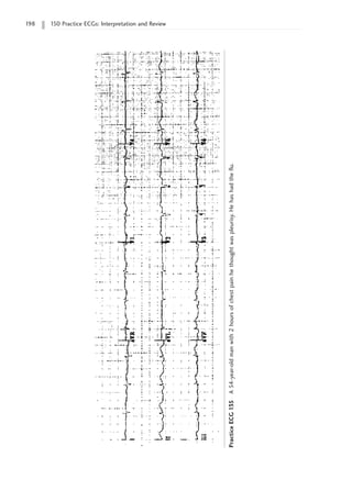 198 150 Practice ECGs: Interpretation and Review
Practice
ECG
135
A
54-year-old
man
with
2
hours
of
chest
pain
he
thought
was
pleurisy.
He
has
had
the
flu.
 