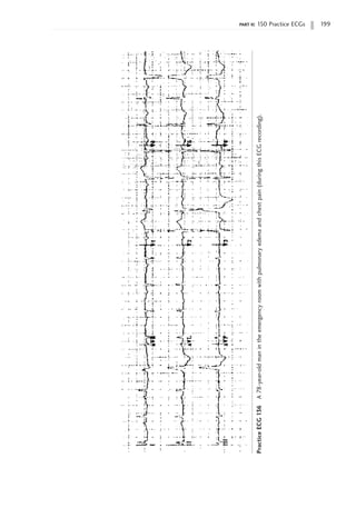 part ii: 150 Practice ECGs 199
Practice
ECG
136
A
78-year-old
man
in
the
emergency
room
with
pulmonary
edema
and
chest
pain
(during
this
ECG
recording).
 