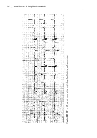 200 150 Practice ECGs: Interpretation and Review
Practice
ECG
137
A
54-year-old
woman
with
a
long
history
of
palpitations;
yearly
examination.
 
