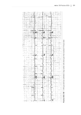 part ii: 150 Practice ECGs 201
Practice
ECG
138
A
48-year-old
man
admitted
2
days
earlier
with
chest
pain
that
resolved
14
hours
later.
 
