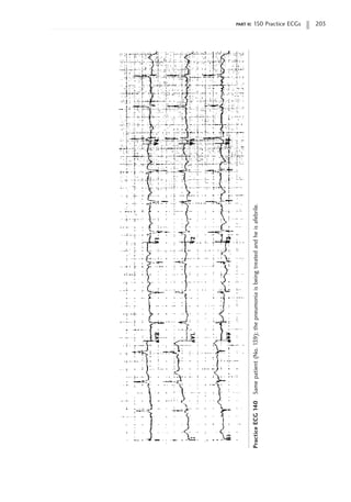 part ii: 150 Practice ECGs 203
Practice
ECG
140
Same
patient
(No.
139);
the
pneumonia
is
being
treated
and
he
is
afebrile.
 