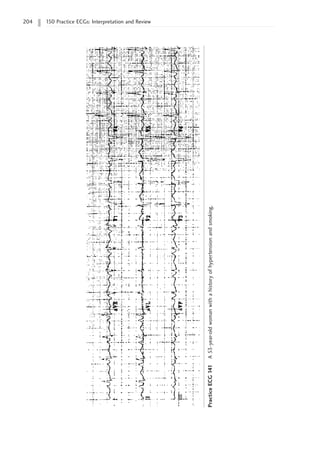 204 150 Practice ECGs: Interpretation and Review
Practice
ECG
141
A
53-year-old
woman
with
a
history
of
hypertension
and
smoking.
 