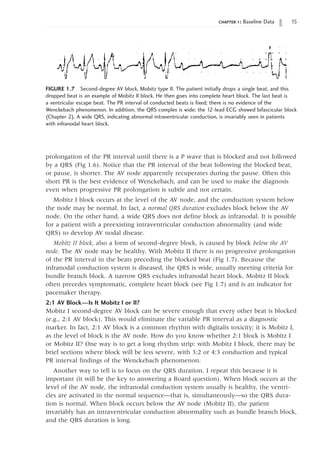 chapter 1: Baseline Data 15
prolongation of the PR interval until there is a P wave that is blocked and not followed
by a QRS (Fig 1.6). Notice that the PR interval of the beat following the blocked beat,
or pause, is shorter. The AV node apparently recuperates during the pause. Often this
short PR is the best evidence of Wenckebach, and can be used to make the diagnosis
even when progressive PR prolongation is subtle and not certain.
Mobitz I block occurs at the level of the AV node, and the conduction system below
the node may be normal. In fact, a normal QRS duration excludes block below the AV
node. On the other hand, a wide QRS does not define block as infranodal. It is possible
for a patient with a preexisting intraventricular conduction abnormality (and wide
QRS) to develop AV nodal disease.
Mobitz II block, also a form of second-degree block, is caused by block below the AV
node. The AV node may be healthy. With Mobitz II there is no progressive prolongation
of the PR interval in the beats preceding the blocked beat (Fig 1.7). Because the
infranodal conduction system is diseased, the QRS is wide, usually meeting criteria for
bundle branch block. A narrow QRS excludes infranodal heart block. Mobitz II block
often precedes symptomatic, complete heart block (see Fig 1.7) and is an indicator for
pacemaker therapy.
2:1 AV Block—Is It Mobitz I or II?
Mobitz I second-degree AV block can be severe enough that every other beat is blocked
(e.g., 2:1 AV block). This would eliminate the variable PR interval as a diagnostic
marker. In fact, 2:1 AV block is a common rhythm with digitalis toxicity; it is Mobitz I,
as the level of block is the AV node. How do you know whether 2:1 block is Mobitz I
or Mobitz II? One way is to get a long rhythm strip: with Mobitz I block, there may be
brief sections where block will be less severe, with 3:2 or 4:3 conduction and typical
PR interval findings of the Wenckebach phenomenon.
Another way to tell is to focus on the QRS duration. I repeat this because it is
important (it will be the key to answering a Board question). When block occurs at the
level of the AV node, the infranodal conduction system usually is healthy, the ventri-
cles are activated in the normal sequence—that is, simultaneously—so the QRS dura-
tion is normal. When block occurs below the AV node (Mobitz II), the patient
invariably has an intraventricular conduction abnormality such as bundle branch block,
and the QRS duration is long.
FIGURE 1.7 Second-degree AV block, Mobitz type II. The patient initially drops a single beat, and this
dropped beat is an example of Mobitz II block. He then goes into complete heart block. The last beat is
a ventricular escape beat. The PR interval of conducted beats is fixed; there is no evidence of the
Wenckebach phenomenon. In addition, the QRS complex is wide; the 12-lead ECG showed bifascicular block
(Chapter 2). A wide QRS, indicating abnormal intraventricular conduction, is invariably seen in patients
with infranodal heart block.
 