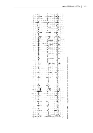 part ii: 150 Practice ECGs 205
Practice
ECG
142
A
72-year-old
woman
with
fever
and
exacerbation
of
chronic
bronchitis.
 