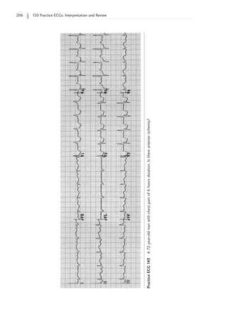 206 150 Practice ECGs: Interpretation and Review
Practice
ECG
143
A
72-year-old
man
with
chest
pain
of
6
hours
duration.
Is
there
anterior
ischemia?
 