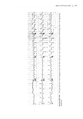 part ii: 150 Practice ECGs 207
Practice
ECG
144
A
59-year-old
man
in
the
emergency
room
with
rales,
chest
pain,
and
a
systolic
blood
pressure
of
80
mm
Hg.
What
is
the
appropriate
treatment?
 