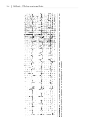 208 150 Practice ECGs: Interpretation and Review
Practice
ECG
145
A
59-year-old
man
who
had
coronary
bypass
surgery
4
weeks
earlier.
For
the
last
week
he
has
had
pleurisy,
fever
and
myalgia.
His
fam-
ily
doctor
began
treatment
for
pneumonia,
but
he
has
not
responded
to
antibiotics.
 