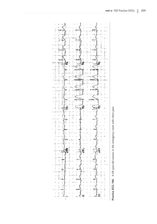 part ii: 150 Practice ECGs 209
Practice
ECG
146
A
69-year-old
woman
in
the
emergency
room
with
chest
pain.
 
