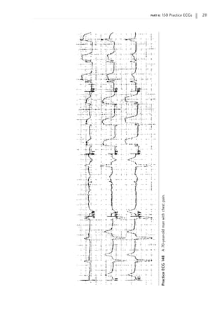 part ii: 150 Practice ECGs 21
1
Practice
ECG
148
A
70-year-old
man
with
chest
pain.
 