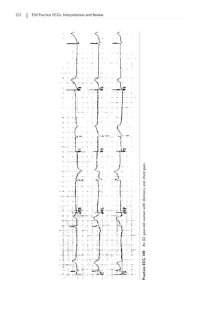 212 150 Practice ECGs: Interpretation and Review
Practice
ECG
149
An
82-year-old
woman
with
dizziness
and
chest
pain.
 