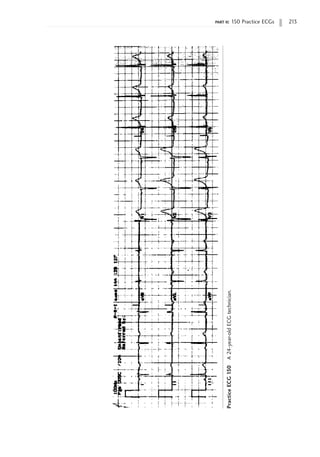 part ii: 150 Practice ECGs 213
Practice
ECG
150
A
24-year-old
ECG
technician.
 