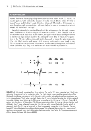 16 150 Practice ECGs: Interpretation and Review
FIGURE 1.8 His bundle recordings from three patients. The goal of EPS when evaluating heart block is to
determine the anatomic level of conduction delay. The His (H) spike is generated by depolarization of the
His bundle, just below and adjacent to the AV node, and is recoded with a bipolar catheter positioned next
to the tricuspid valve. The H spike essentially divides the PR interval into its AV nodal (the AH interval) and
infranodal (HV) portions. Patient A: the PR interval is normal as is the HV interval (55msec). Patient B: A
patient with first-degree AV block (long PR). Marked prolongation of the AH interval indicates that the level
of block is the AV node. Infranodal conduction (the HV interval) is normal. Patient C: Another with first-
degree AV block. The AH interval is normal, so there is no delay in conduction in the AV node. The pro-
longed HV interval indicates infranodal conduction delay. With infranodal disease there is a higher risk of
developing symptomatic heart block. (Reproduced with permission from Taylor GJ. Primary care management
of heart disease. St. Louis, MO: Mosby, 2000.)
PATHOPHYSIOLOGY
Here is how the electrophysiology laboratory assesses heart block. As noted, an
elderly person with infranodal disease—bundle branch block—may develop a
sick AV node and Mobitz I block. Whether it is really Mobitz I or II block can be
sorted out in the electrophysiology lab, especially when there is uncertainty about
a need for pacemaker therapy.
Depolarization of the proximal bundle of His, adjacent to the AV node, gener-
ates a small current that is not apparent on the surface ECG. This “H spike” can be
measured with an electrode that is near it, using an electrode catheter positioned
in the lower right atrium next to the tricuspid valve. The H wave allows parti-
tion of the PR interval into its nodal, and infranodal, or infra-His spike segments
(Fig 1.8). Block in the node causes A-H interval prolongation, and block below
the node—below the proximal His—causes H-V interval prolongation. Infranodal
block identified by a long H-V interval is an indication for a pacemaker.
 