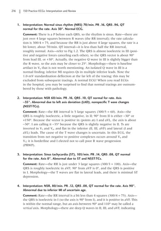 216 150 Practice ECGs: Interpretation and Review
1. Interpretation: Normal sinus rhythm (NRS) 70/min. PR .16, QRS .96, QT
normal for the rate. Axis 30°. Normal ECG.
Comment: There is a P before each QRS, so the rhythm is sinus. Rate—there are
just over 4 large squares between R waves (the RR interval); the rate calcula-
tion is 300/4 = 75, and because the RR is just above 4 large squares, the rate is a
bit lower, about 70/min. QT interval—it is less than half the RR interval,
roughly normal. Axis—refer to Fig 1.2. The QRS is almost isoelectric in III (posi-
tive and negative forces canceling each other), so the QRS vector is about 90°
from lead III, or +30°. Actually, the negative Q wave in III is slightly bigger than
the R wave, so the axis may be closer to 25°. Morphology—there is baseline
artifact in V6 that is not worth mentioning. An isolated Q wave in III is a
normal finding; inferior MI requires Qs in multiple inferior leads. Note the
1.0-mV standardization deflection at the far left of the tracing; this may be
excluded from subsequent tracings. A normal ECG! When you read ECGs
in the hospital, you may be surprised to find that normal tracings are outnum-
bered by those with pathology.
2. Interpretation: NSR 60/min. PR .16, QRS .10, QT normal for rate. Axis
-35°. Abnormal due to left axis deviation (LAD), nonspecific T wave changes
(NSST-TCs).
Comment: Rate—the RR interval is 5 large squares (300/5 = 60). Axis—the
QRS is roughly isoelectric, a little negative, in II; 90° from II is either -30° or
+150°. Because the vector is positive in (points at) I and aVL, the axis is about
-30°. I am calling it -35° because the QRS is slightly negative in II. Ts are
inverted in V5 and V6, and flat in the inferior (II, III, aVF) and lateral (I and
aVL) leads. The cause of the T wave changes is uncertain. In this ECG, the
transition from net negative to positive complexes occurs around V4 and
V5; it is borderline and I elected not to call poor R wave progression
(PRWP).
3. Interpretation: Sinus tachycardia (ST), 105/min. PR .14, QRS .08, QT normal
for the rate. Axis 0°. Abnormal due to ST and NSST-TCs.
Comment: Rate—the RR is just under 3 large squares (300/3 = 100). Axis—the
QRS is roughly isoelectric in aVF; 90° from aVF is 0°, and the QRS is positive
in I. Morphology—the T waves are flat in lateral leads, and there is minimal ST
depression.
4. Interpretation: NSR, 80/min. PR .12, QRS .08, QT normal for the rate. Axis 90°.
Abnormal due to inferior MI of uncertain age.
Comment: Rate—the RR interval is a bit less than 4 squares (300/4 = 75). Axis—
the QRS is isoelectric in I (so the axis is 90° from I), and it is positive in aVF. This
is within the normal range, but an axis between 90° and 110° may be called a
vertical axis. Morphology—there are deep Q waves in II, III, and aVF, indicating
 