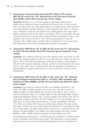 218 150 Practice ECGs: Interpretation and Review
7. Interpretation: Supraventricular tachycardia (SVT) 160/min, PR uncertain,
QRS .06, QT normal. Axis -50°. Abnormal due to SVT, left anterior fascicular
block (LAFB), anterior MI of uncertain age, and low voltage.
Comment: Rhythm—it is a narrow complex tachycardia (with narrow
QRSs) and no obvious P waves (could they be buried in the T wave in lead
II?). It is a bit too fast for sinus tachycardia in an elderly person. The atrial rate
with atrial flutter is usually 300/min, so the ventricular rate with 2:1 conduc-
tion is 150/min. It may be a bit slower in an elderly patient, but rarely faster.
With a ventricular rate of 160, flutter is less likely. SVT is a reasonable call, and
it would include ST as well as other supraventricular arrhythmias. Axis—to be
negative in II, it has to be left of -30°, and I am guessing far to the left
(beyond -45°), which makes it LAFB. There are deep Qs in V1–V3; most with
this finding have had an MI, although false positives are possible.
8. Interpretation: NSR 70/min. PR .16, QRS .08, QT normal. Axis 10°. Abnormal due
to anterior MI and probably inferior MI of uncertain age and nonspecific T wave
changes.
Comment: Axis—almost isoelectric, but a bit negative in III, so the axis is to the
left of 30°; strongly positive in aVF, so it is to the right of 0°. There are Qs in V1
and V2. MI is the correct interpretation, although it could be a false positive.
The Q in aVF is broad, although not deep, and there is the deep Q in III. Ts are
flat in I, aVL, and V5 and V6. Heart failure may be attributed to ischemic car-
diomyopathy in a patient with Q waves in two of the three coronary artery
distributions.
9. Interpretation: NSR 75/min. PR .22, QRS .1
1, QT normal. Axis -50°. Abnormal
due to first-degree atrioventricular block (1° AV block), LAFB, incomplete right
bundle branch block (IRBBB), and left ventricular hypertrophy (LVH) with repolar-
ization changes.
Comment: If you did not measure the PR, you probably missed the 1° AV
block. The QRS is deeply negative in II, so the axis is far left of -30°; it is
slightly negative in aVR, placing the axis just to the right of -60°. I count 7
points for LVH (see Table 2.1): voltage (deep S in III), prolonged QRS, delayed
intrinsicoid deflection (look at aVL, a good example of the delay in the time to
reach peak voltage), and LAD. The ST-T changes in V4–V6 are probably due to
LVH, but it is not the classic strain pattern. A couple of problems with this
ECG: Why not inferior MI? There are small positive glitches, R waves in infe-
rior leads, so there are no Qs. What about the tall R in V1? Look closely at that
lead: at first glance, the QRS looks narrower than in V2. V1 actually has an rsR
pattern, not quite RBBB, as the QRS is not wide enough—but close (I call it
IRBBB). LAFB + RBBB would not change the final diagnosis of LVH.
Would bifascicular block plus 1° AV block raise the possibility of incipient trifas-
cicular (complete) heart block and syncope? Not necessarily, as most patients
with this pattern are found to have PR prolongation because of delayed con-
 