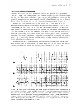 chapter 1: Baseline Data 17
Third-Degree, Complete Heart Block
Complete atrioventricular block is just that; nothing gets through to the ventricles.
There are P waves and QRS complexes, but they are unrelated; this is called AV dissocia-
tion (Fig 1.9). The term is used when P waves are not followed by QRS complexes; the
atria and ventricles operate independently. Complete heart block is just one of the con-
ditions where this occurs, and you will encounter other examples in Chapter 2.
How do you know whether block occurs within the AV node itself, or in the
infranodal conduction system? The issues are those discussed above with 2:1 AV block.
When block is at the level of the AV node, the takeover pacemaker is just below the
node, within the His bundle and before the division into the bundle branches (see Fig
1.3). The sequence of ventricular activation is therefore normal, and the QRS duration
is normal (unless there is coexisting bundle branch block). Furthermore, the takeover
pacemaker is relatively high in the conduction system and has an intrinsic rate ranging
from 35 to 45 beats/min. The rate would probably increase with catecholamine infu-
sion or administration of atropine.
When complete block develops in the infranodal conduction system, the takeover
pacer is in the body of the ventricle, the QRS is wide, and the rate is low. This may be
called an idioventricular rhythm, but it should not be mistaken as a ventricular
FIGURE 1.9 Three patients with complete heart block. The atria are being discharged at a regular rate (P
waves) and the ventricles at a regular rate (QRS complexes). The two rhythms appear unrelated; there is AV
dissociation. You may be tempted to say that P waves coming before QRS complexes could be conducted,
but these do not alter the regularity of the ventricular escape rhythm. Patients A and B have wide QRS
complexes and slow ventricular rates; they probably have block below the AV node, with a takeover pace-
maker in the body of the ventricle. Patient C has a more rapid escape rate (55 beats/min), and the QRS
complex is narrow; the level of block is the AV node.
 